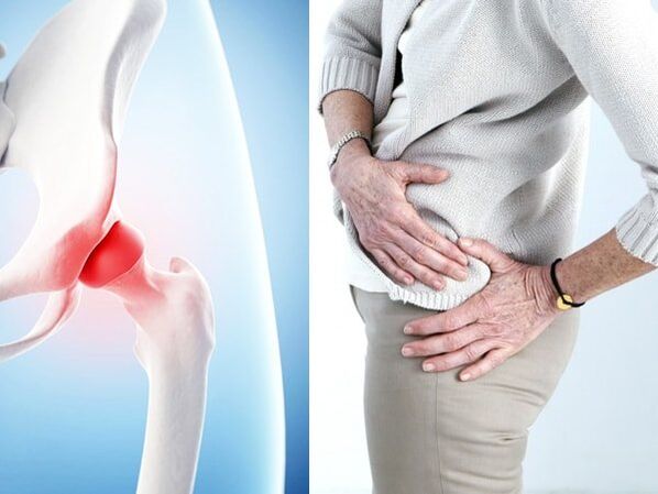 symptoms of arthrosis of the hip joint
