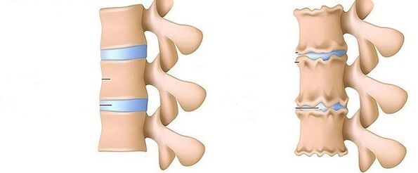 healthy spine and osteochondrosis
