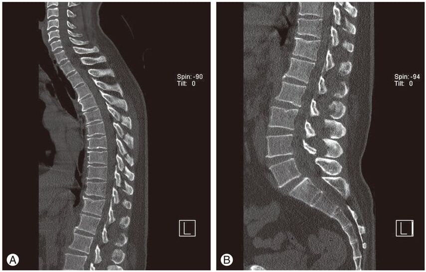 Deformation of the intervertebral disc on MRI images in thoracic osteochondrosis