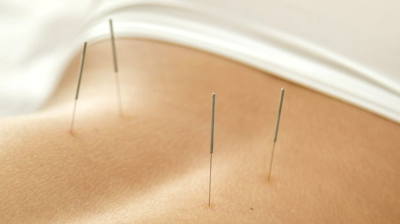 Acupuncture will help relieve back pain