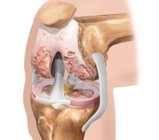 The articular cartilage of the knee