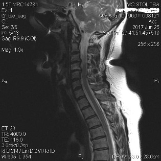 Osteocondrose and spondylosis in the cervical spine